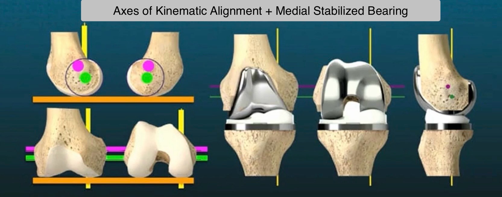 Personalized kinematic knee alignment surgical planning