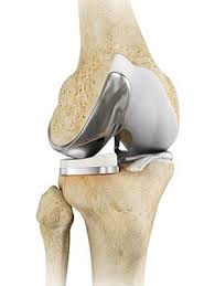 Knee replacement recovery results